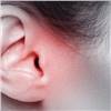 Kulak Zarı Ameliyatı